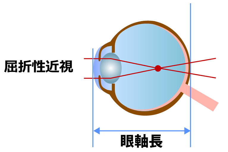 屈折性近視