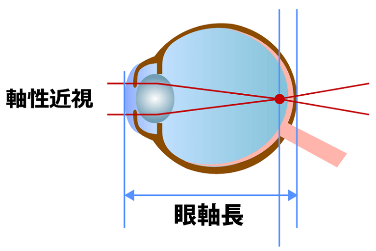 軸性近視