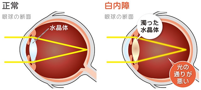 愛媛県で白内障手術ならいしづち眼科