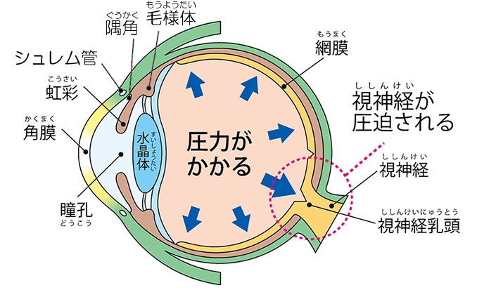 緑内障ってどんな病気？