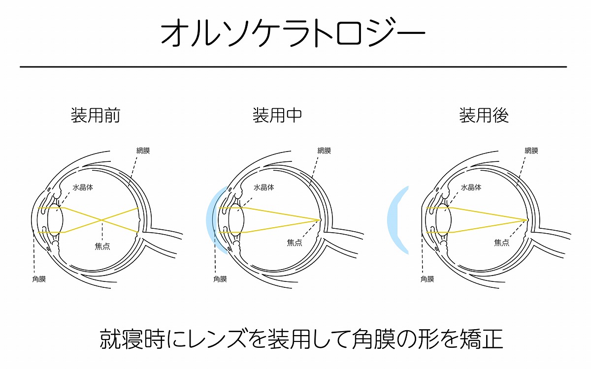 寝ている間に視力矯正ができるオルソケラトロジー