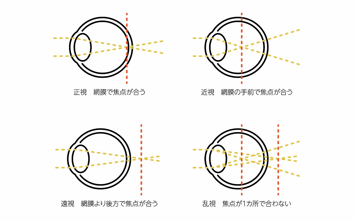 どんな見え方？屈折異常とは