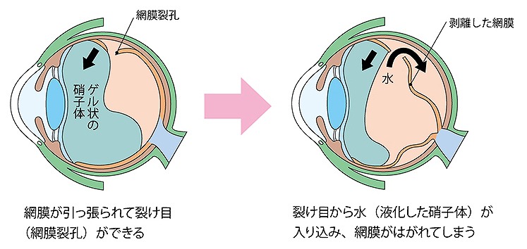 失明にも繋がる網膜剥離とは