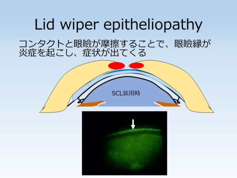 まぶたとの摩擦