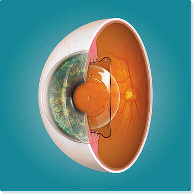 角膜を削らず、近視・遠視・乱視を矯正するICL（眼内コンタクトレンズ）